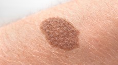 Waspada Kanker Melanoma, Kenali Perbedaan Tahi Lalat Normal dan Tidak