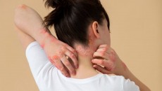 Bikin Malu, Ini Penyebab Munculnya Infeksi Jamur di Kulit