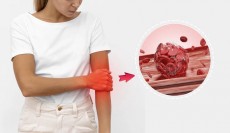 Ciri-ciri Kolesterol Tinggi dan Tips Menurunkannya