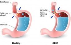 Penderita GERD Tetap Aman dan Nyaman Berpuasa, Perhatikan Tips Berikut