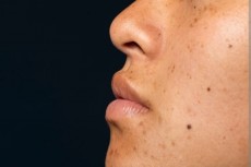 Tahi Lalat Bisa Jadi Tanda Peringatan Indikasi Kanker Kulit