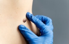 Ini Cara Efektif Hilangkan Kutil dengan Aman