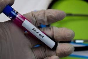 Pasien Wanita dengan HIV Sembuh setelah Jalani Transplantasi Sel Induk