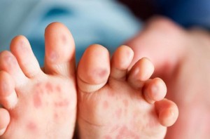 Mengenal Penyakit HFMD, Dokter Anak: Jangan Panik