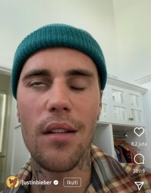 Mengenal Ramsay Hunt, Penyebab Separuh Wajah Justin Bieber Lumpuh