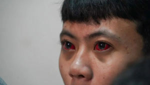 Dialami Korban Tragedi Kanjuruhan, Ini Risiko Pendarahan Mata