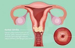 Pentingnya Pap Smear untuk Skrining Awal Kanker Serviks