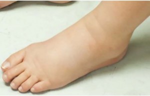 Tips Mengatasi Kaki Bengkak Ibu Hamil