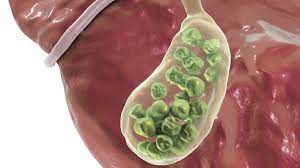 Nyeri Perut Kanan hingga Bahu Disertai Mual, Waspadai Gejala Batu Empedu