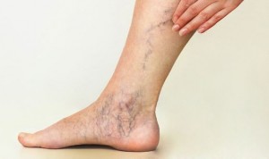 Picu Komplikasi pada Penderita, Varises Jangan Dianggap Sepele