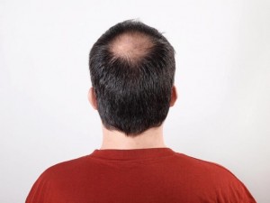 Tips Rawat Rambut Hindari Masalah Kebotakan