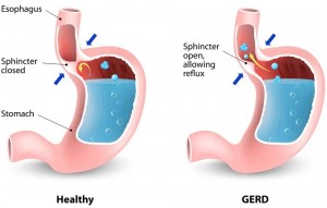 Penderita GERD Tetap Aman dan Nyaman Berpuasa, Perhatikan Tips Berikut