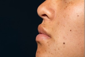 Tahi Lalat Bisa Jadi Tanda Peringatan Indikasi Kanker Kulit