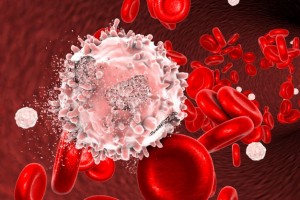 Selain Kemoterapi Ada Terapi Seluler untuk Penyakit Leukemia