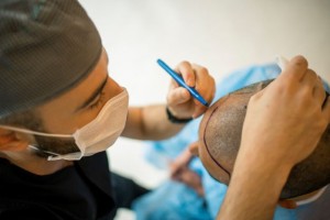 Lagi Tren, Bolehkah Transplantasi Rambut dalam Islam?