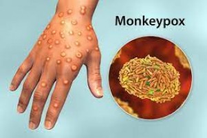 Wabah Monkeypox Meningkat, Ahli Epidemologi Unair Tekankan Pencegahan