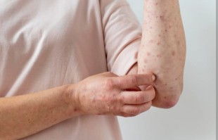 4 Tanda Gejala Lupus, Segera Periksa ke Dokter