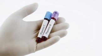 Kasus Hepatitis Akut Misterius Meningkat, Waspada Gejala Ini pada Anak