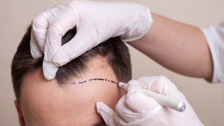 Terungkap, Segini Harga Transplantasi Rambut Selebritas Tanah Air