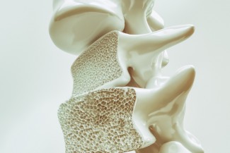 Cara Cegah Osteoporosis, Dokter: Cukupkan Kalsium dan Vitamin D