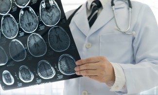 Dokter UNAIR Ungkap Penyebab Pembuluh Darah di Kepala Pecah