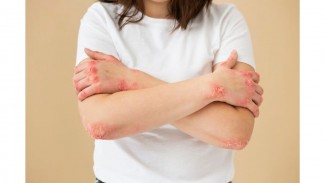 Ahli Kesehatan Sebut Konsumsi Makanan Ultraproses Picu Psoriasis