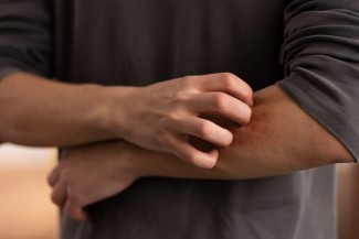 Tips Kurangi Keinginan Menggaruk saat Menderita Eksim