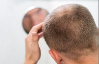 Nutrisi Ini Cegah Kebotakan dan Bikin Rambut Sehat