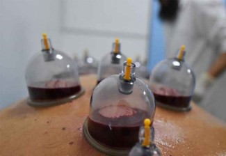 Bekam Saat Puasa Dibolehkan: Rasulullah Hapus Larangan Lama demi Kemudahan Ibadah dan Kesehatan Umat