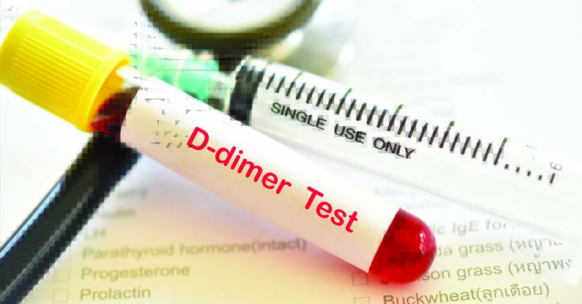 Waspada Nilai D-Dimer Meningkat pada Pasien Post Covid 19