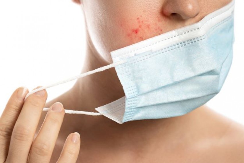 Pakai Masker Terlalu Lama Sebabkan Jerawat, Ini Solusinya