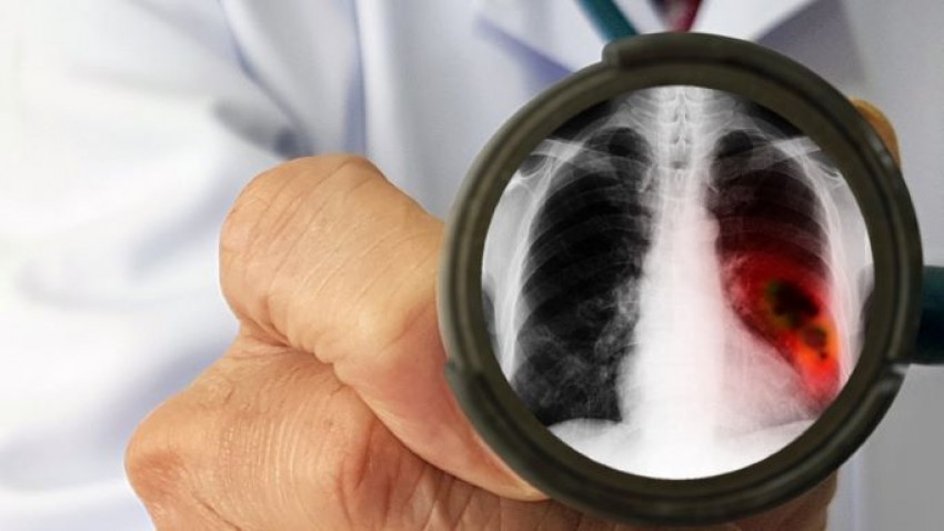 Angka Kematian Tinggi, Lebih dari 30 Ribu Orang di Indonesia Didiagnosa Kanker Paru
