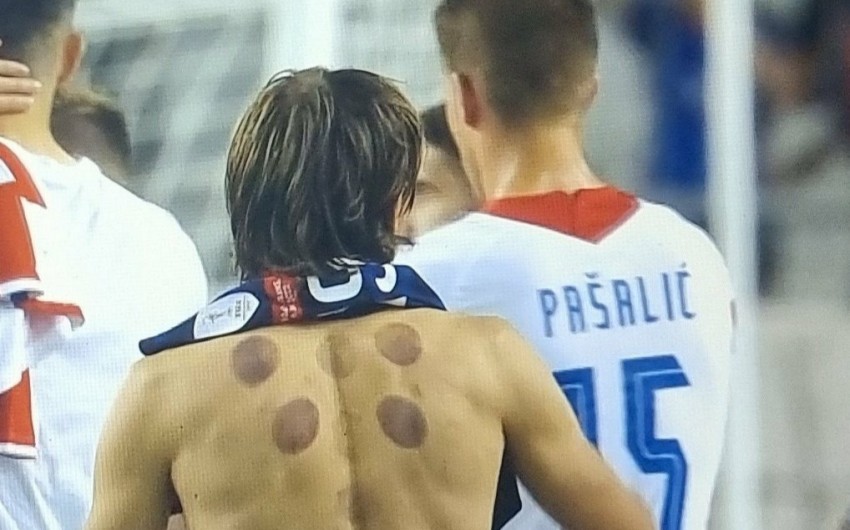 Terinspirasi Benzema, Luka Modric Jaga Kebugaran dengan Bekam