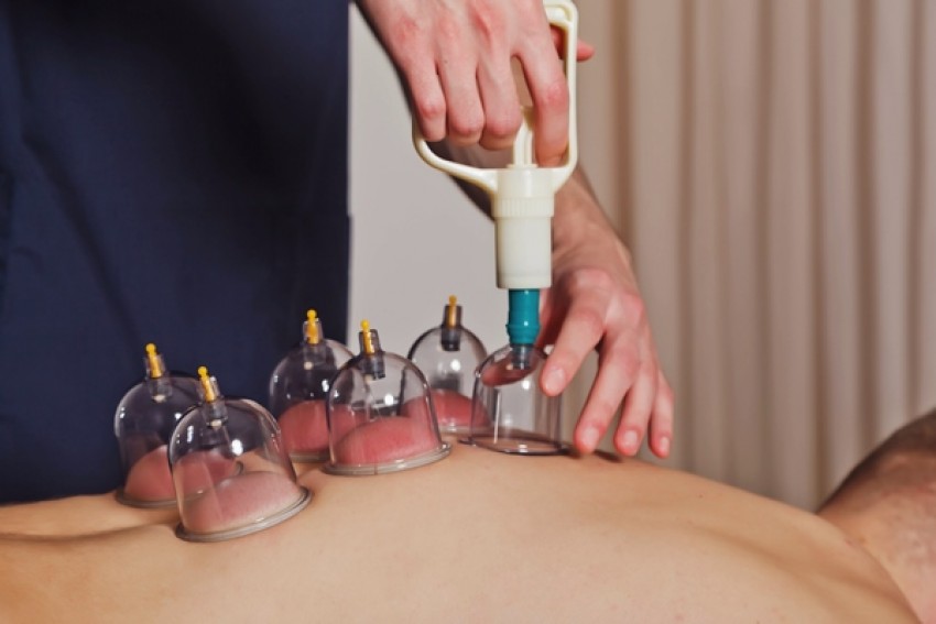 Jarang Diketahui, Ini 4 Manfaat Bekam Bagi Kesehatan Tubuh