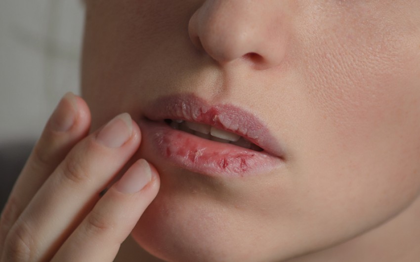 Seringkali Terlupa, Ini Penyebab Bibir Kering Saat Musim Hujan