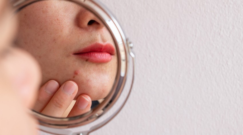 Mengenal Skin Barrier, Ciri-ciri Kerusakan hingga Cara Merawatnya