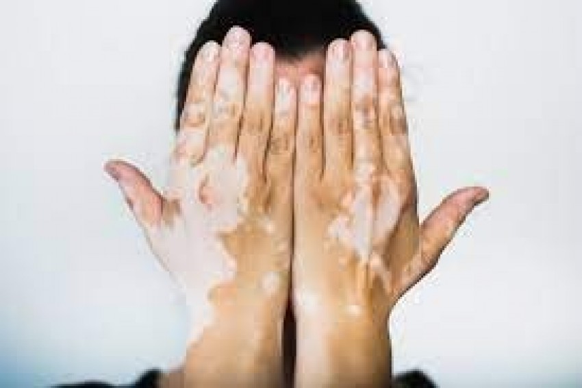 Apa Itu Vitiligo, Penyebab dan Penanggulangannya? Ini Penjelasan Dokter