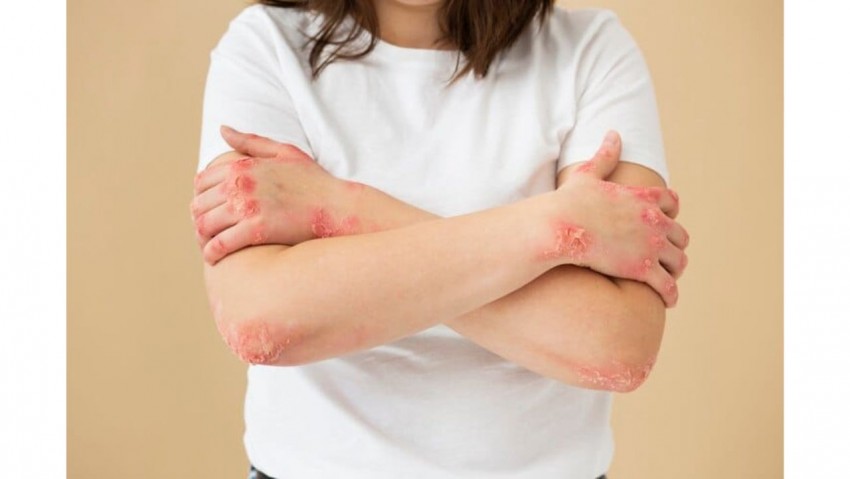 Ahli Kesehatan Sebut Konsumsi Makanan Ultraproses Picu Psoriasis