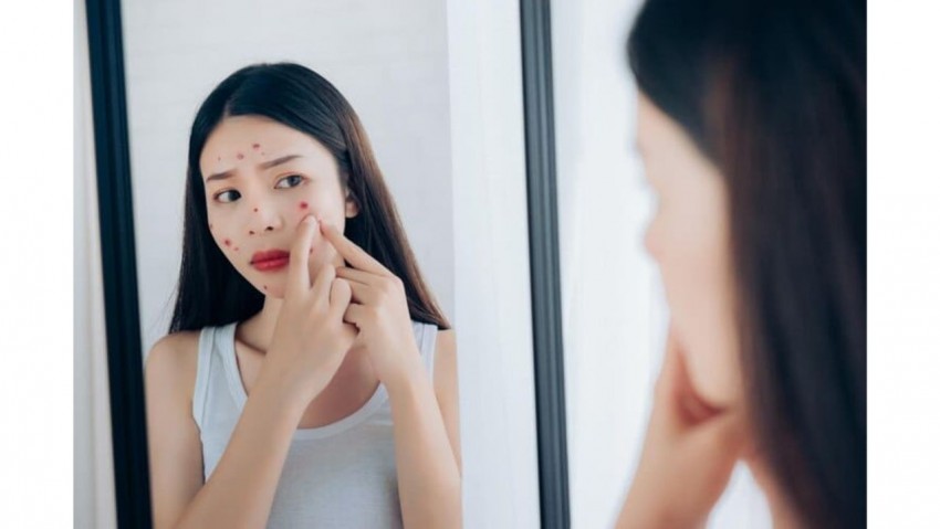 7 Penyebab Jerawat Sering Muncul, Bikin Tidak Percaya Diri