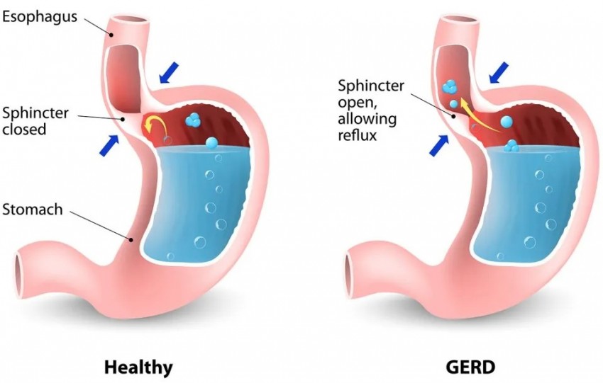 Penderita GERD Tetap Aman dan Nyaman Berpuasa, Perhatikan Tips Berikut