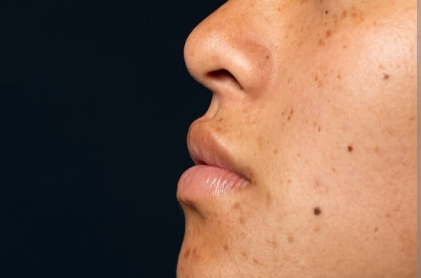 Tahi Lalat Bisa Jadi Tanda Peringatan Indikasi Kanker Kulit