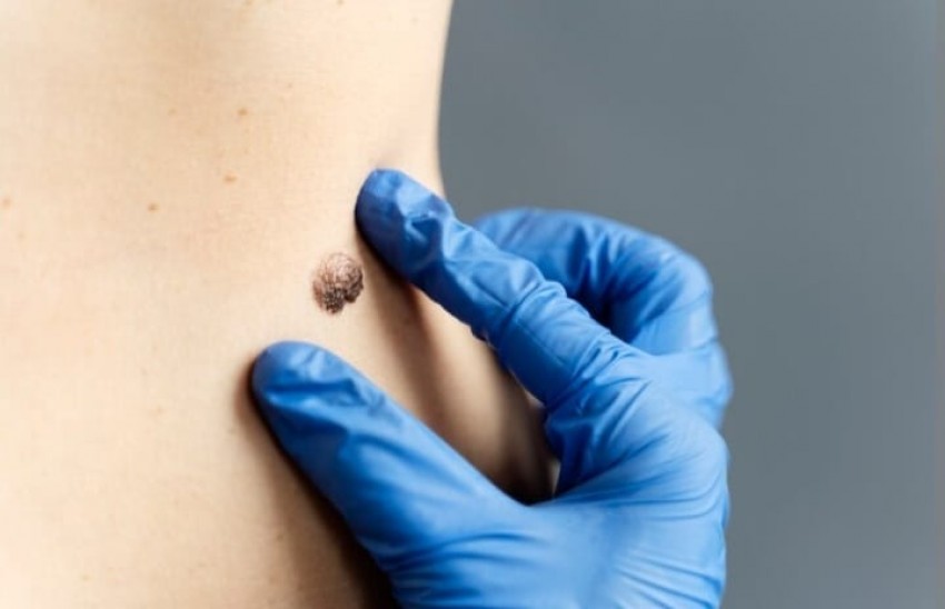 Ini Cara Efektif Hilangkan Kutil dengan Aman