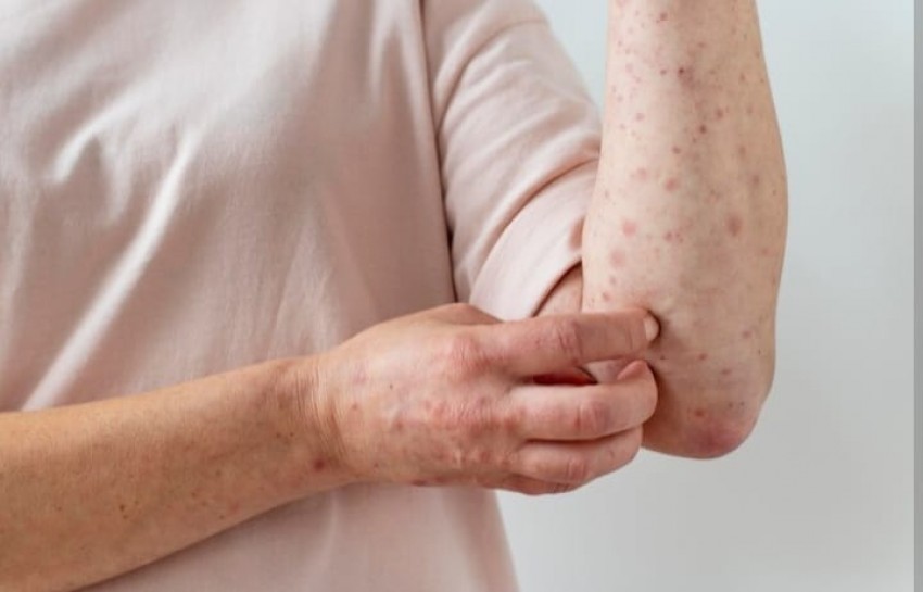 4 Tanda Gejala Lupus, Segera Periksa ke Dokter