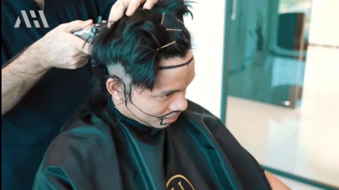 4 Artis Lakukan Transplantasi Rambut, Mantu dan Mertua Ikut Ubah Penampilan